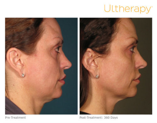 ultherapy
