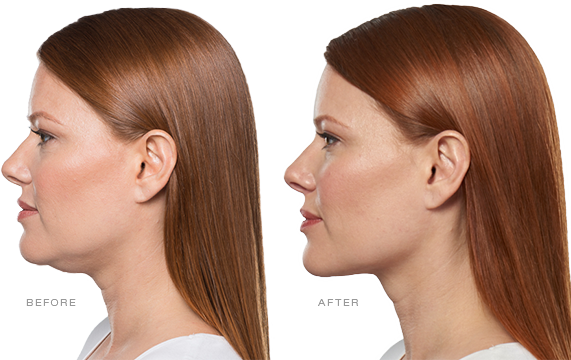 Kybella, kybella before and after