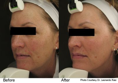 pearl laser resurfacing treatment