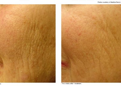 pearl laser resurfacing treatment