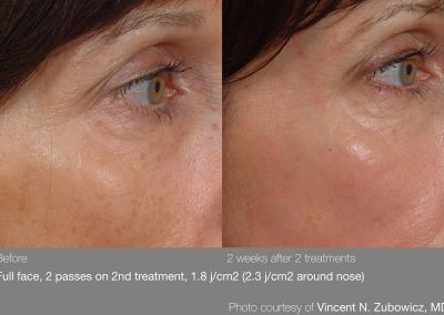 pearl laser resurfacing treatment