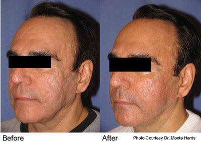 pearl laser resurfacing treatment