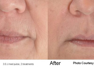 pearl laser resurfacing treatment