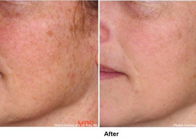 pearl laser resurfacing treatment