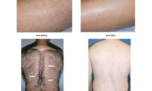 Laser Hair Removal - Accent Aesthetics