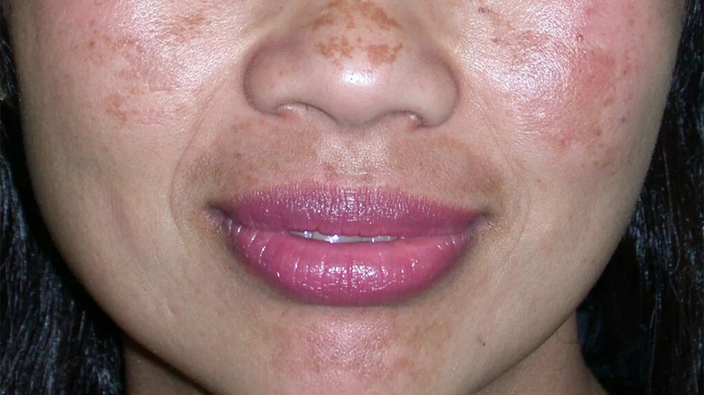 melasma