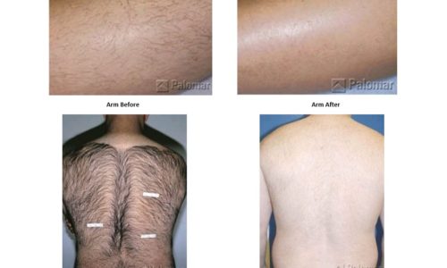 Best Laser Hair Reduction Near Denver Accent Aesthetics