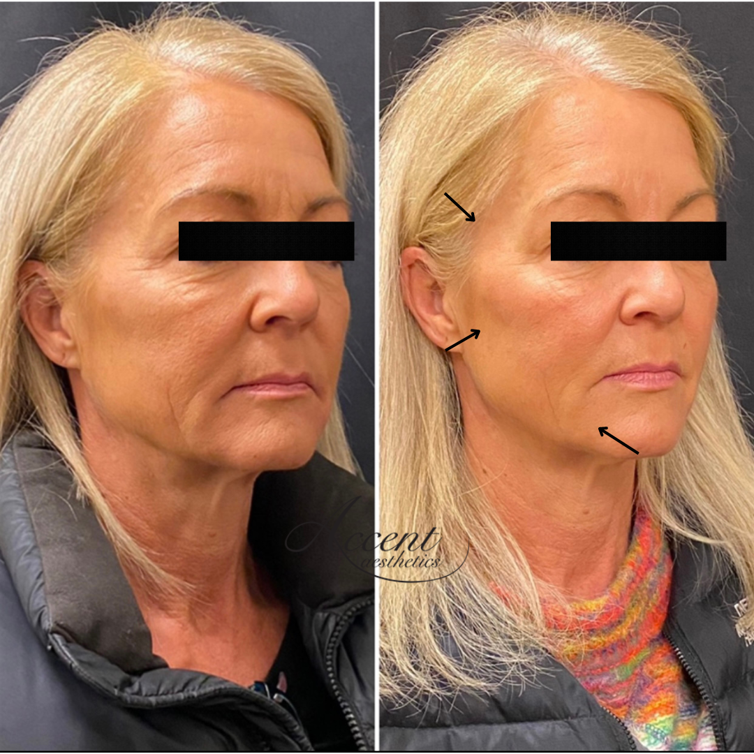 gallery, sculptra dermal fillers