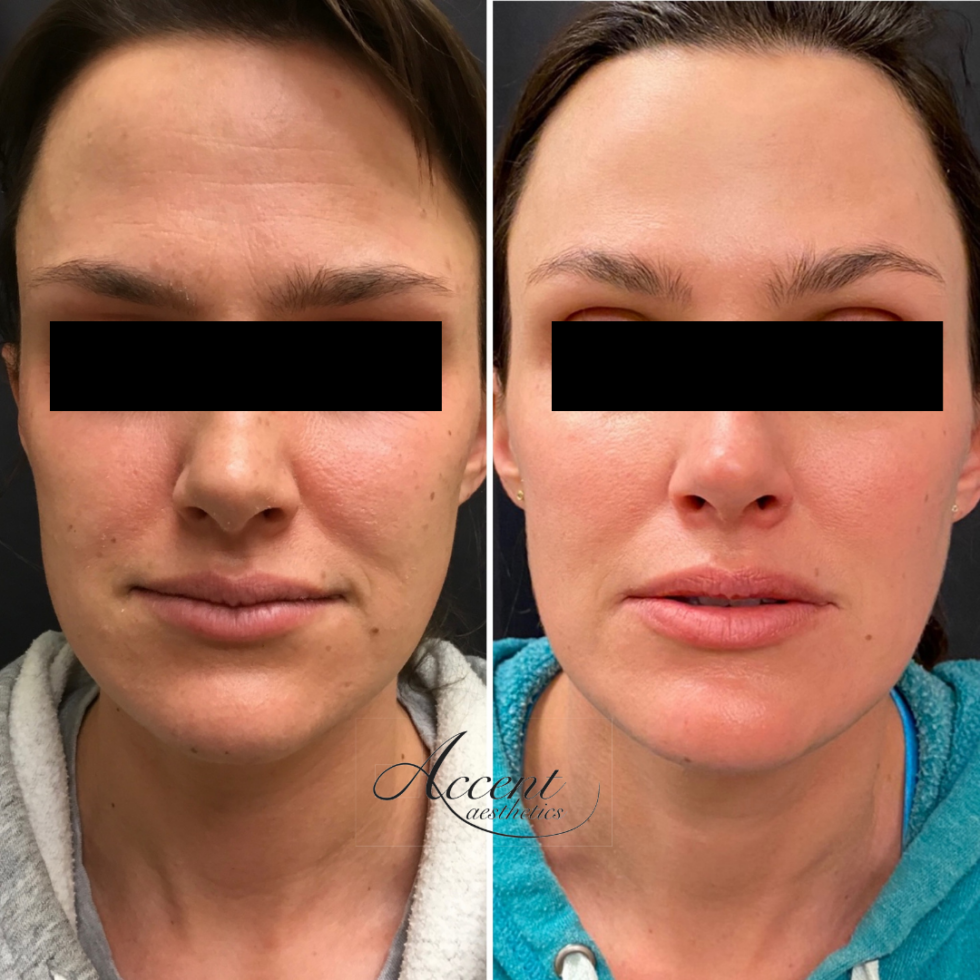 Dermal Fillers: What's Best For You? | Sculptra Vs Radiesse