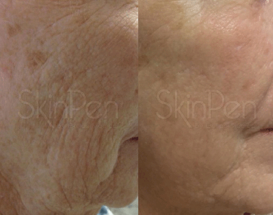 SkinPen Microneedling