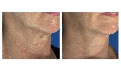 Radio Frequency Microneedling