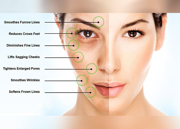 microneedling, benefits of microneedling, skinpen microneedling