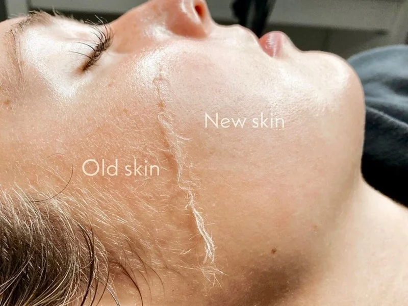 DERMAPLANING, DERMAPLANING TREATMENT, hydrating vs moisturizing